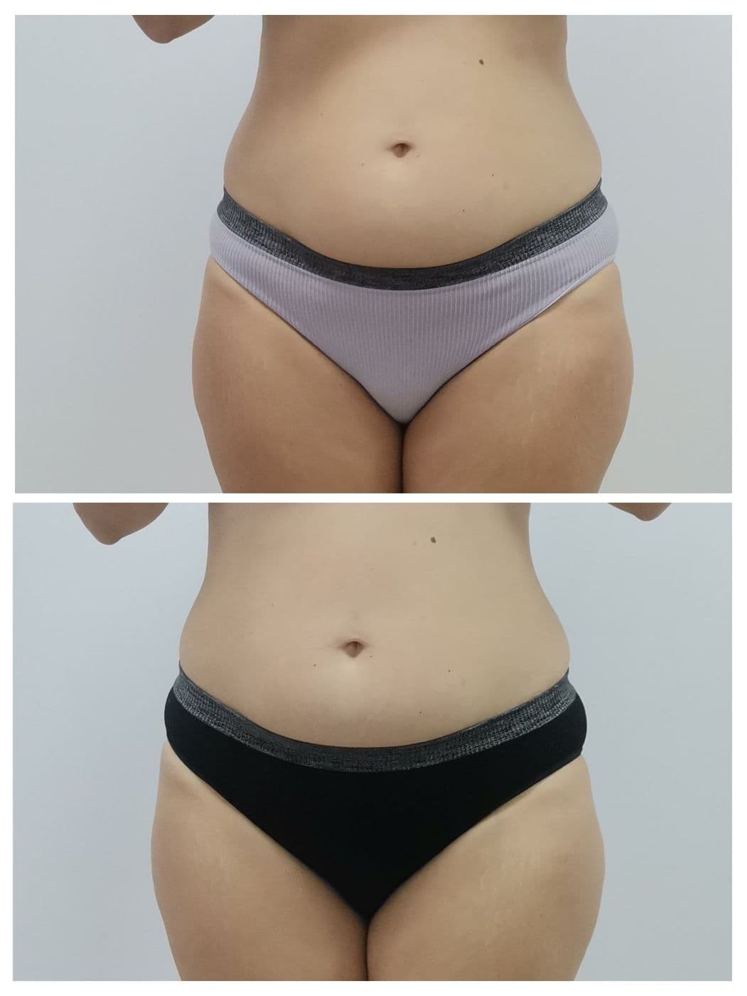 Sculpt Pro и пресотерапия: преди и след