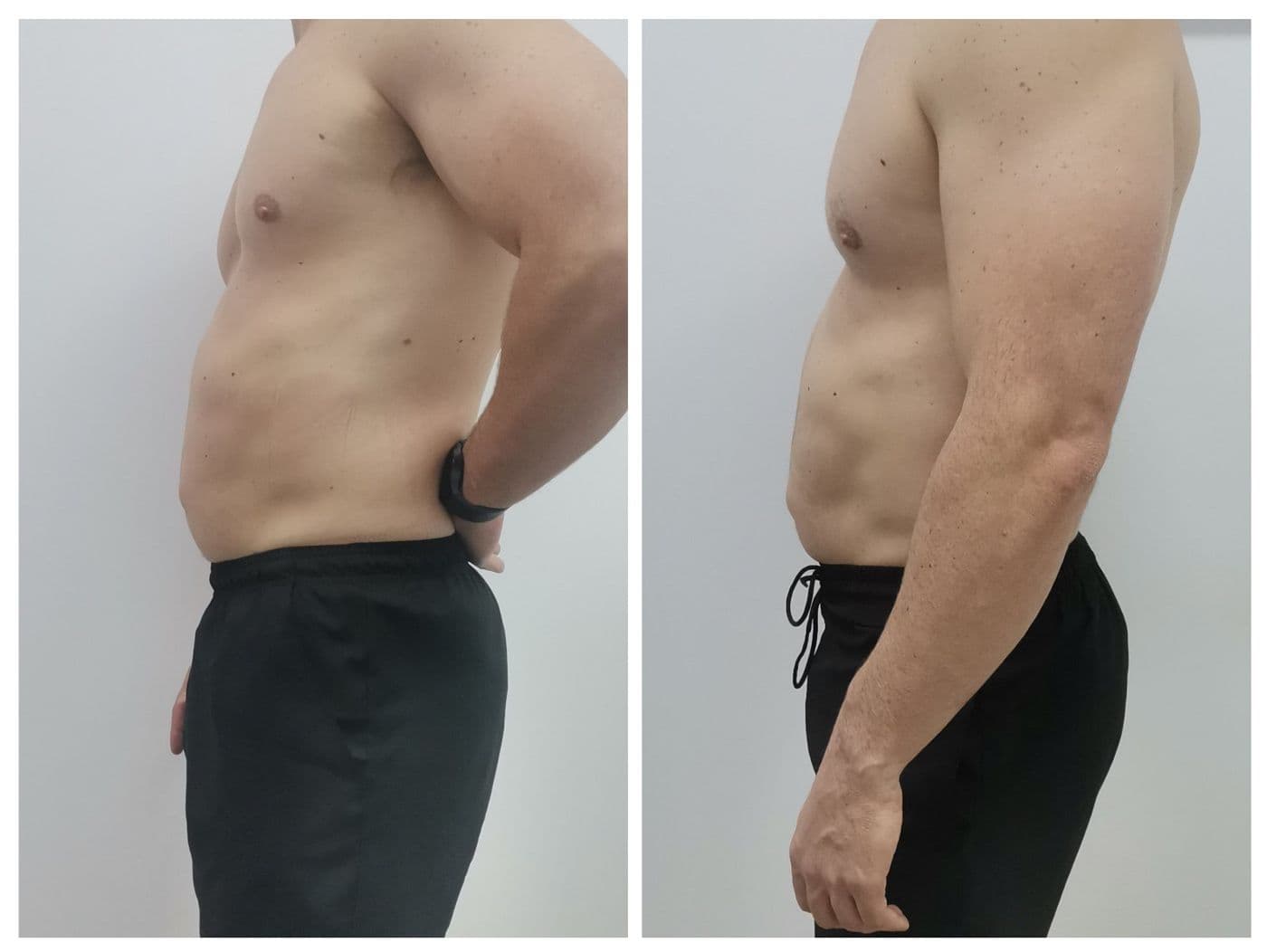 Sculpt Pro и пресотерапия: преди и след