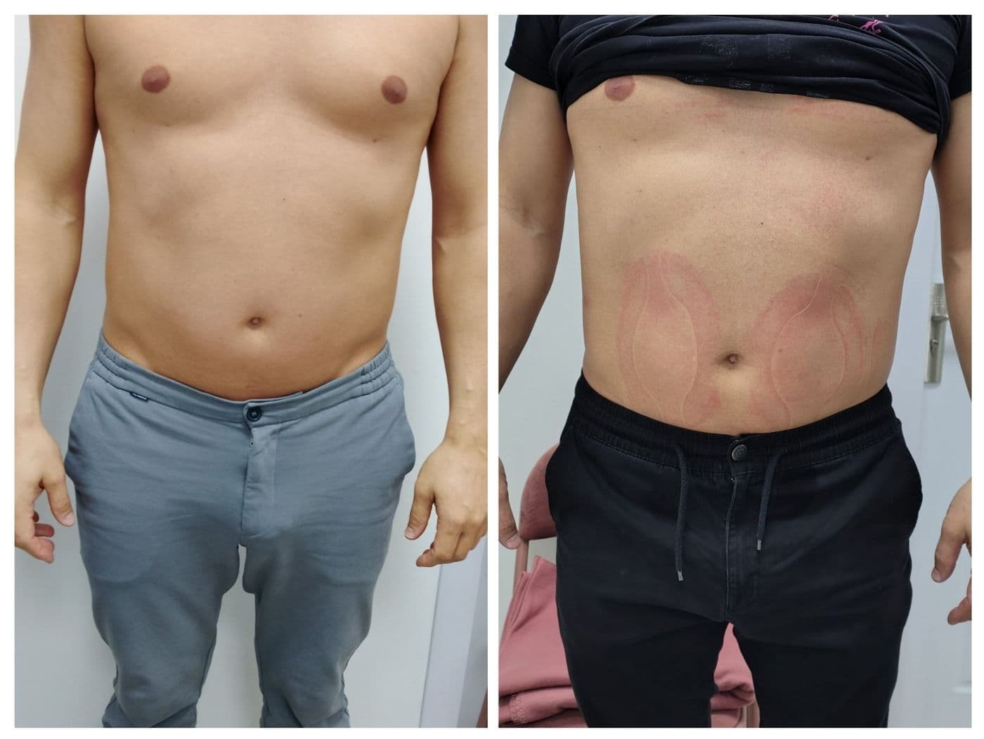 Sculpt Pro и пресотерапия: преди и след